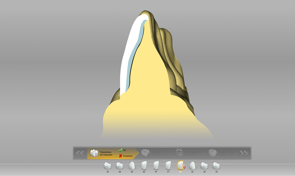 Установленный винир на зубе