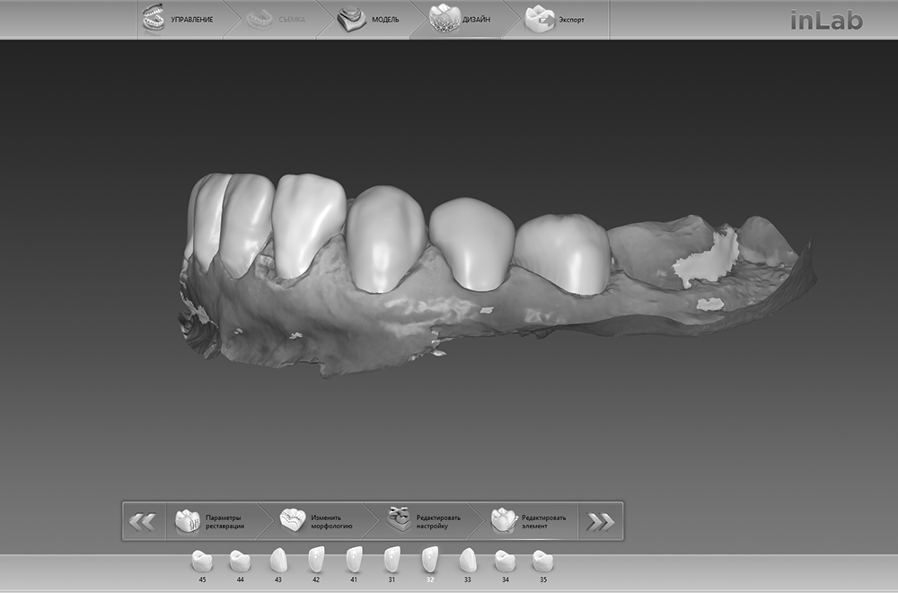 Виготовлення вінірів