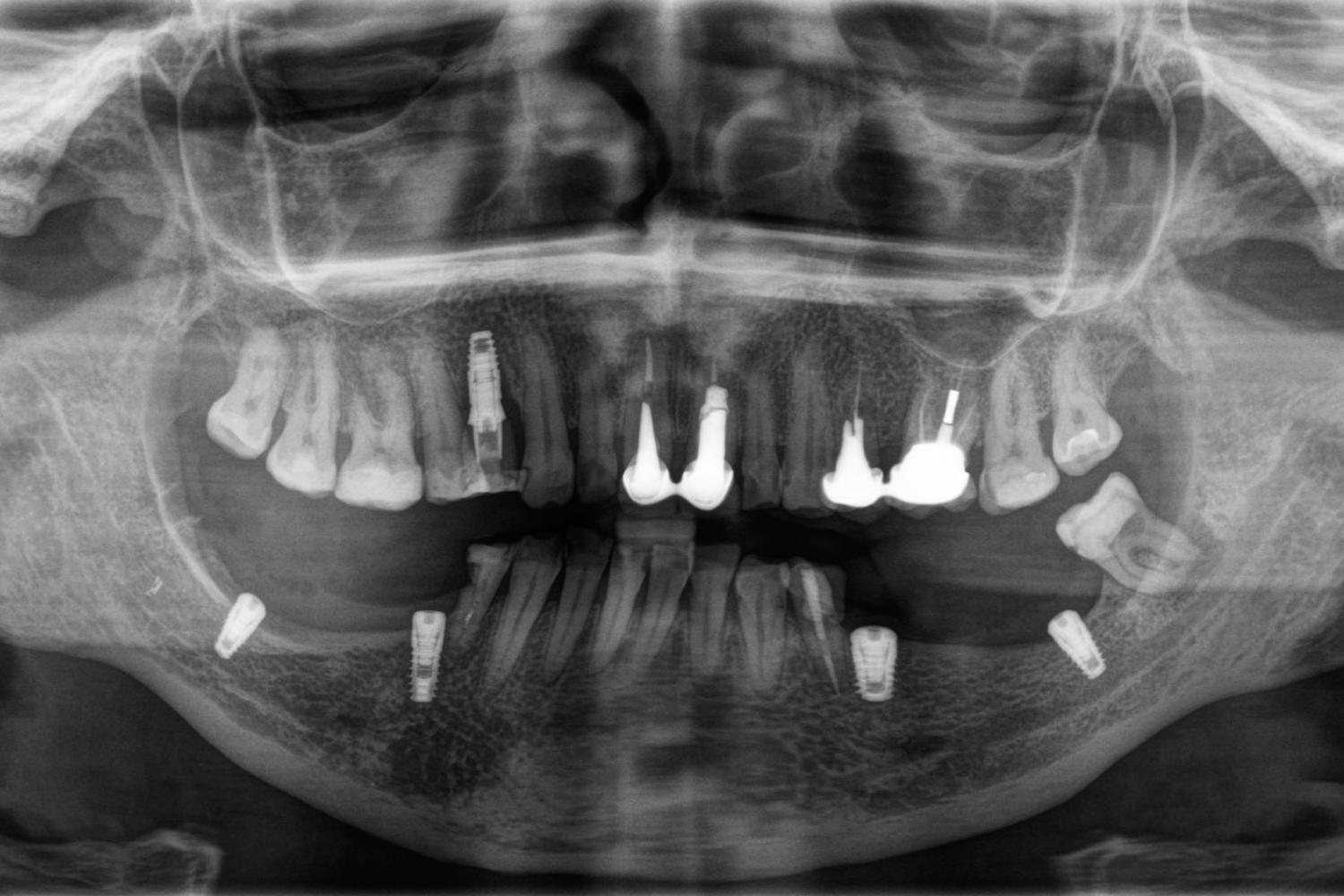 КТ зубів після імплантації