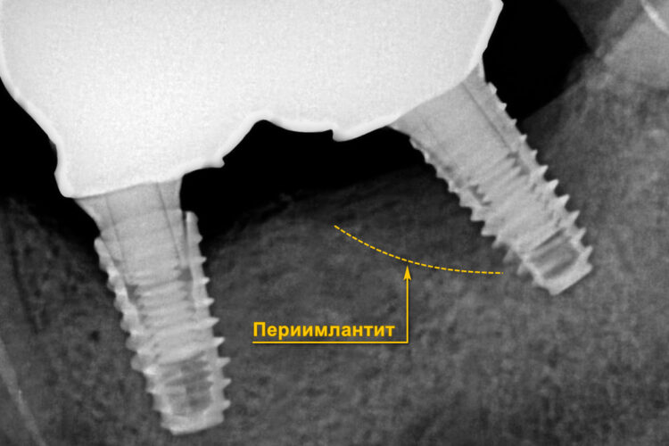 переимплантит
