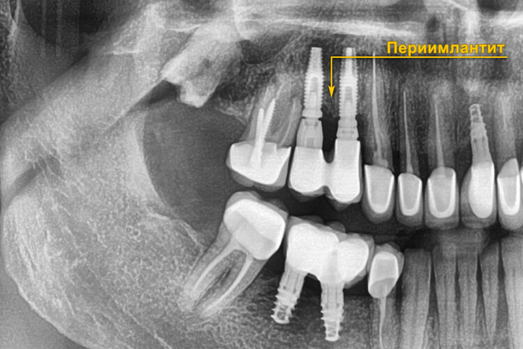 переимплантит