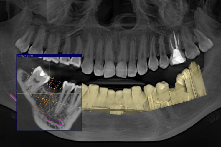 Планирование установки импланта