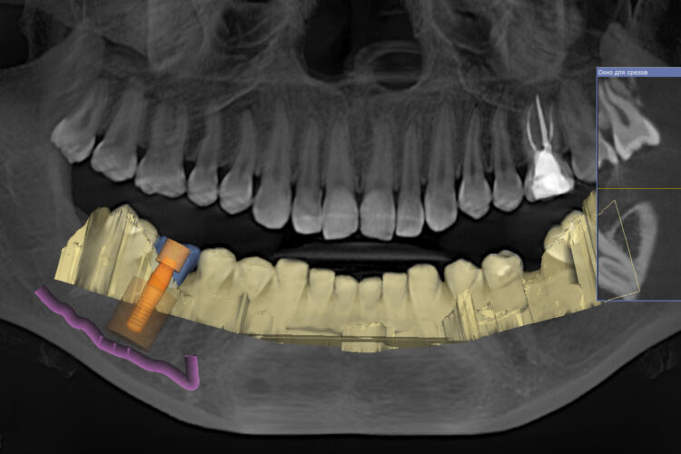 Планирование установки импланта