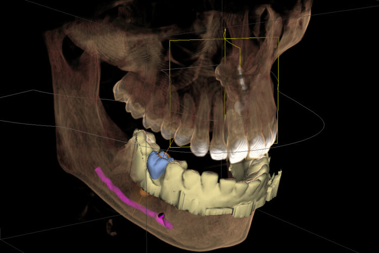 Планирование установки импланта