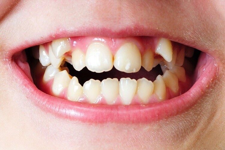 скученность зубов