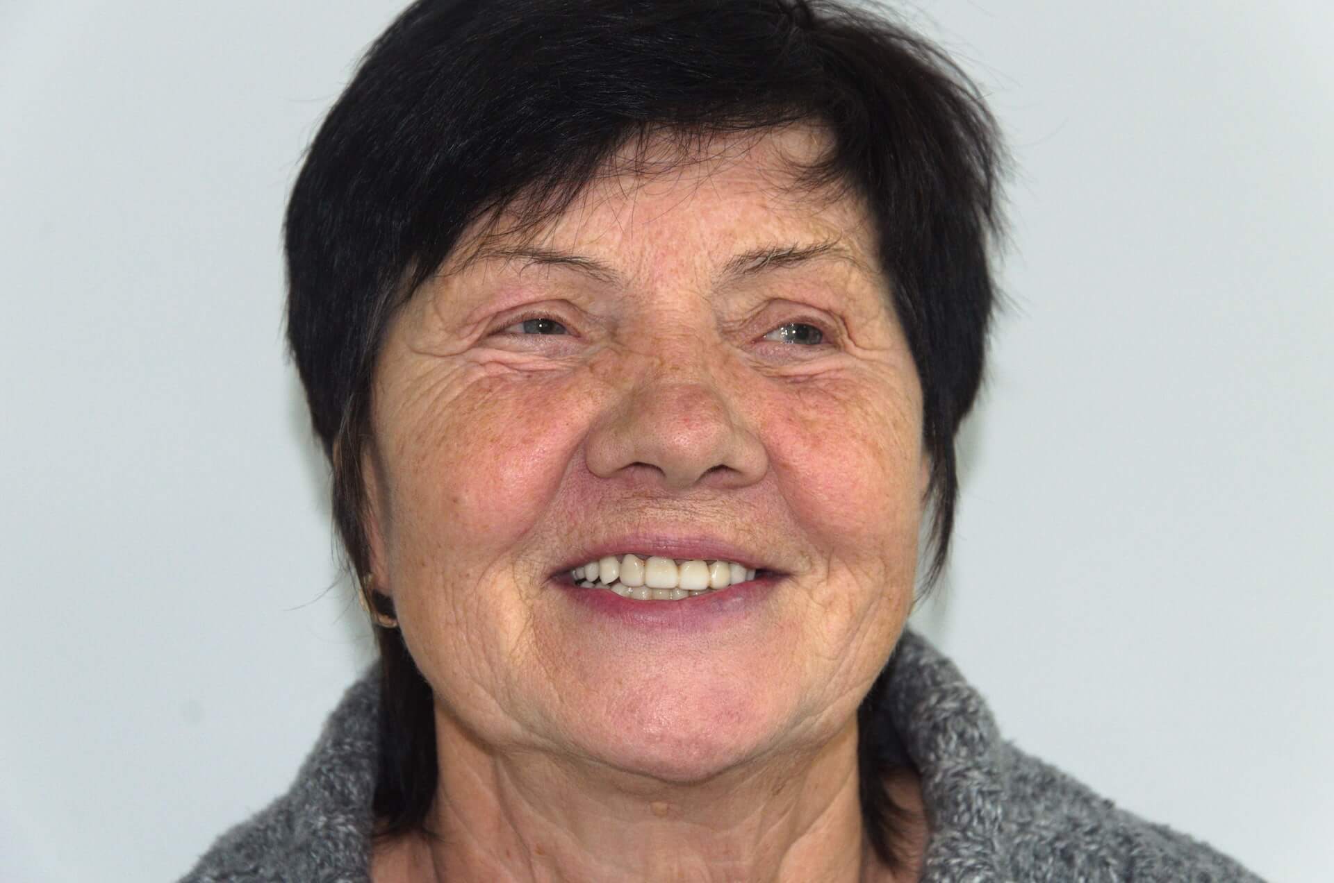 імплантація зубів