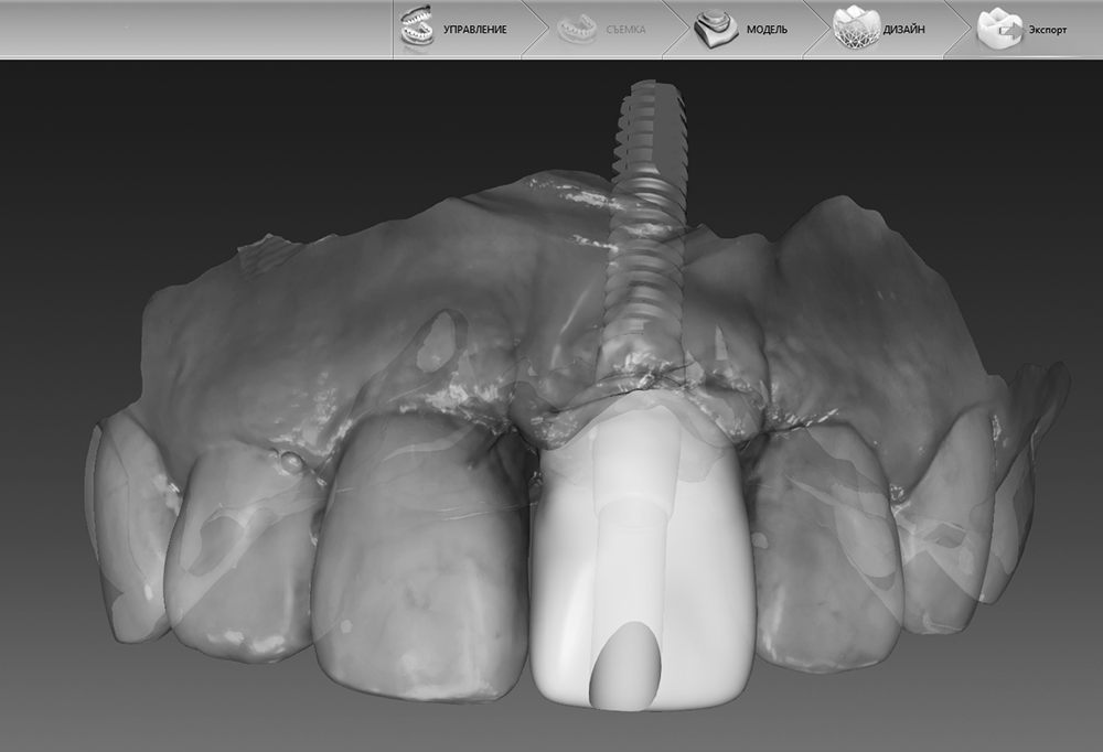 Имплантация передних зубов