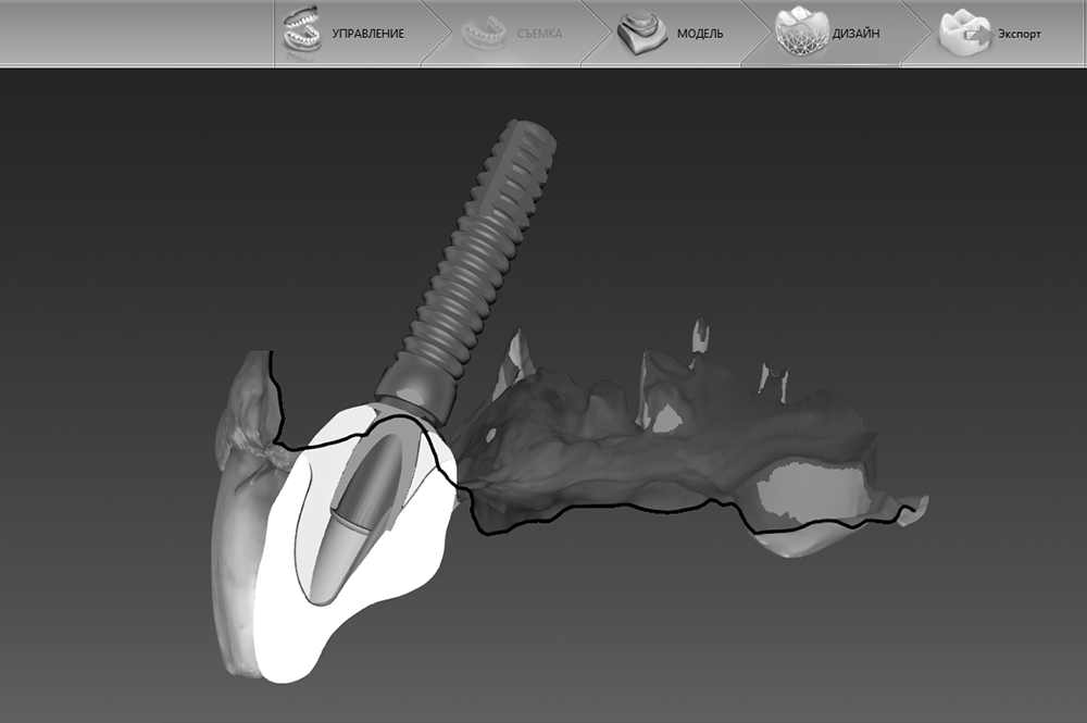 Имплантация передних зубов