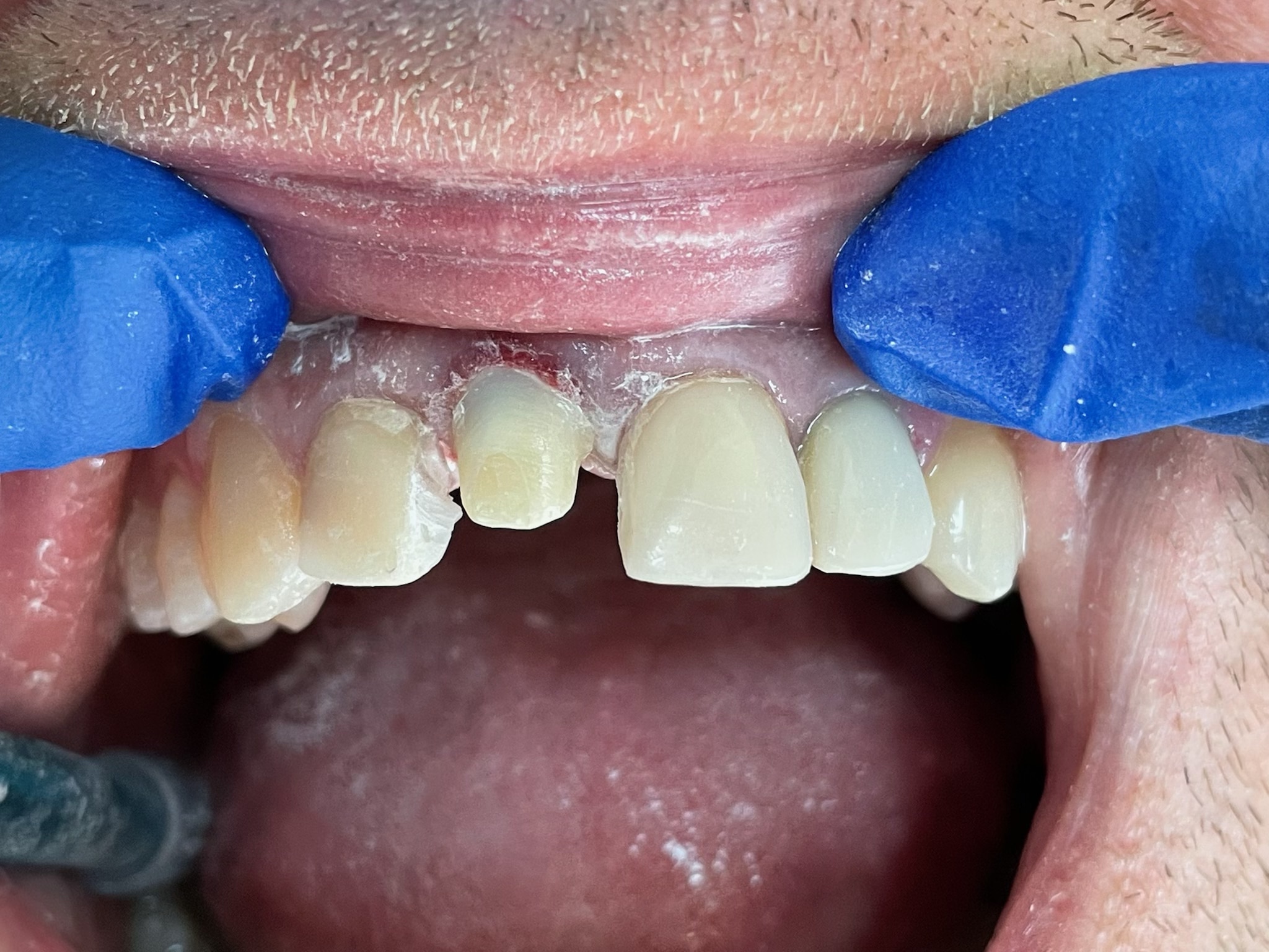 вкладка зубная