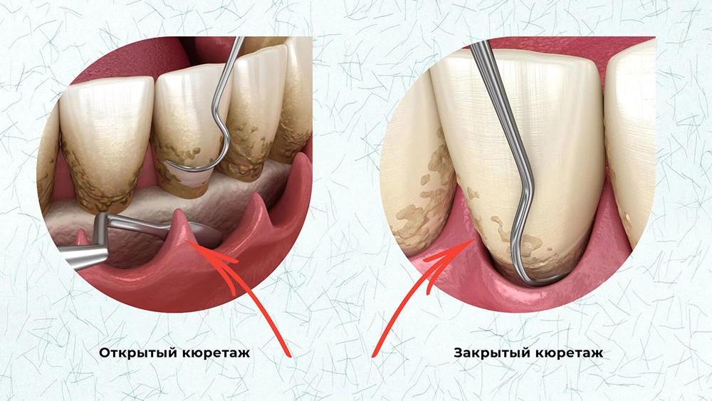 открытый и закрытый кюретаж