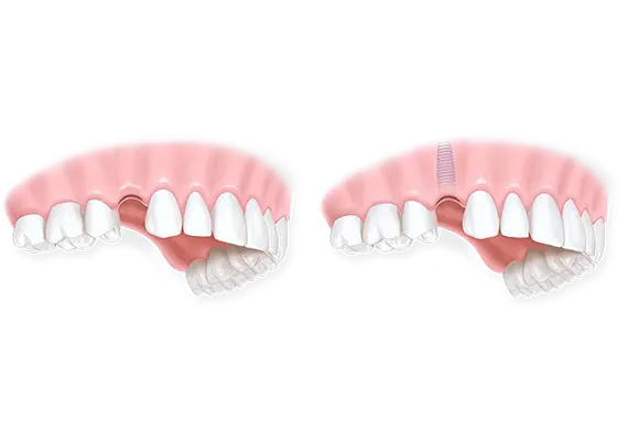 Имплантация зубов