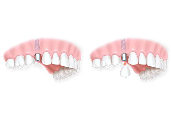 Имплантация зубов