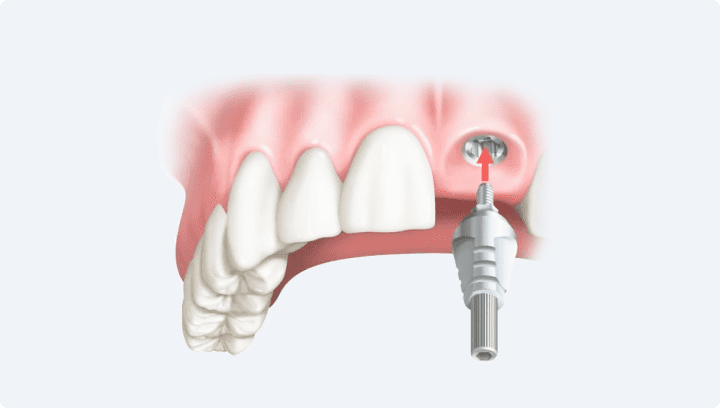 Одномоментно