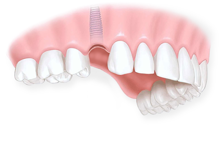 имплантация зубов