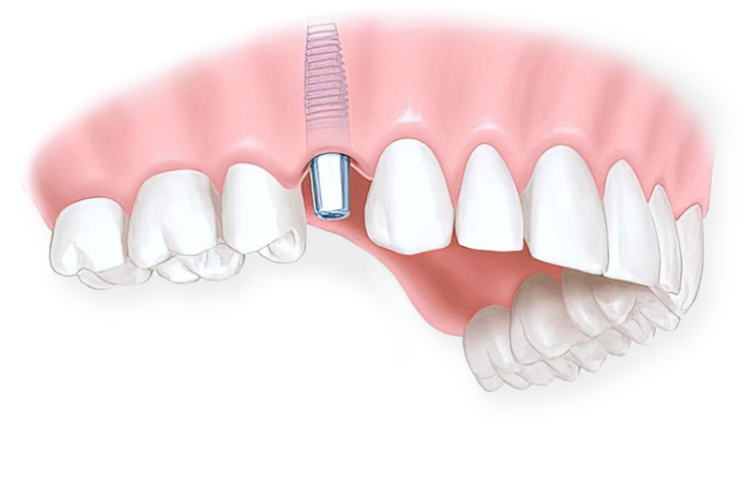имплантация зубов