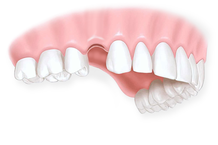 имплантация зубов