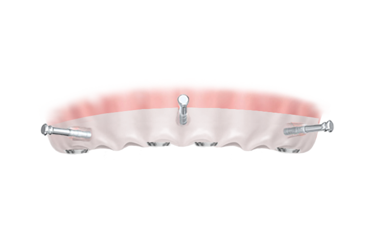 Имплантация All-on-4