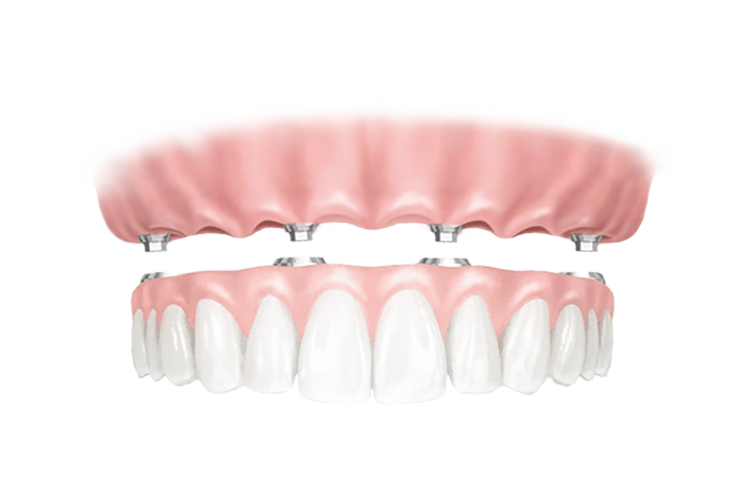 Имплантация All-on-4