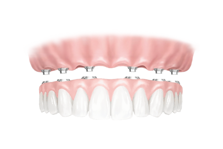 Имплантация All-on-6
