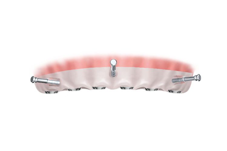 Имплантация All-on-6