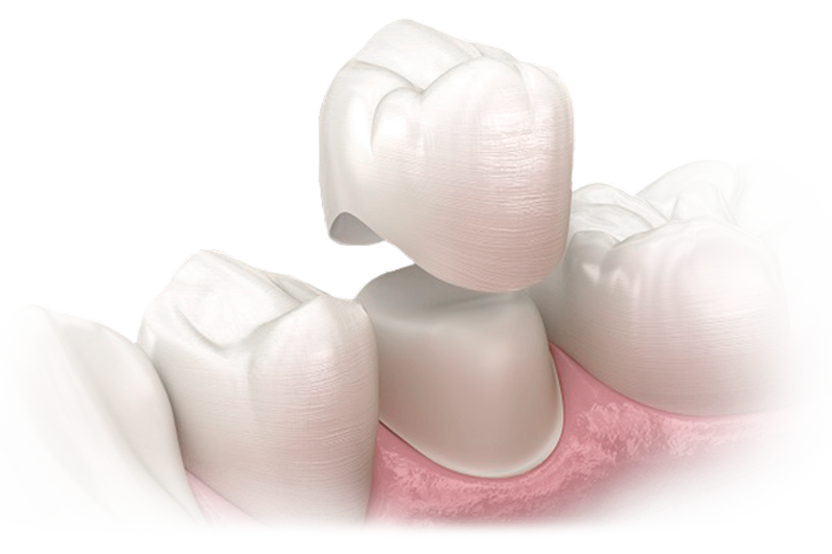 Протезування зубів