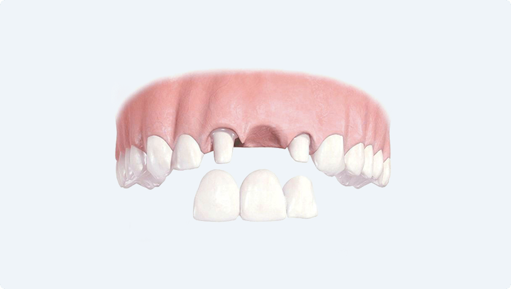 Протезирование зубов