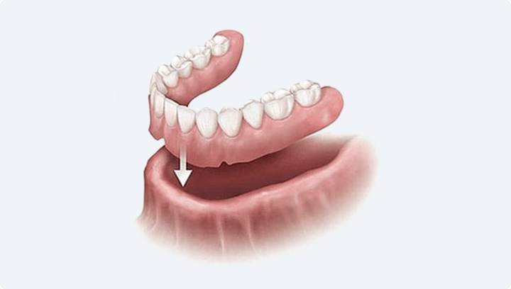 Протезирование зубов