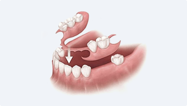 Протезирование зубов