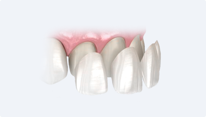 Протезирование зубов