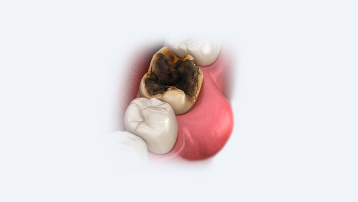 Зубний біль і його причини