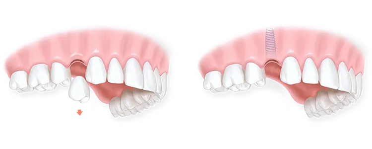 Етапи проведення одномоментної імплантації