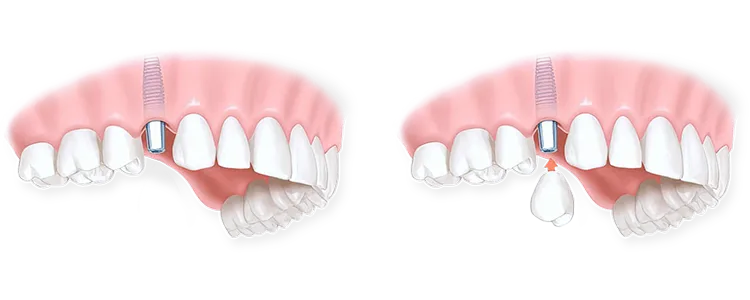 Етапи проведення одномоментної імплантації