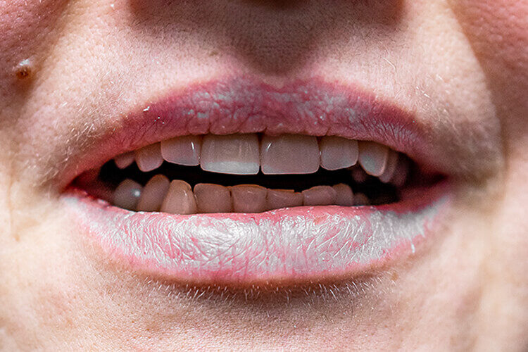 Реставрация передних зубов