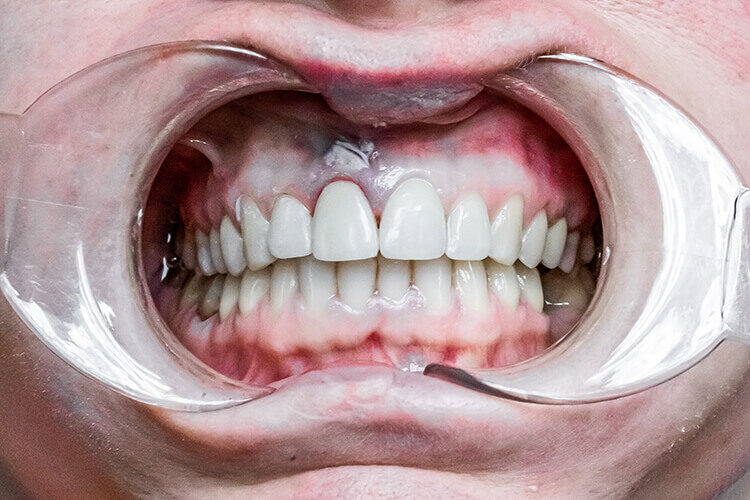 Сложная реставрация переднего зуба