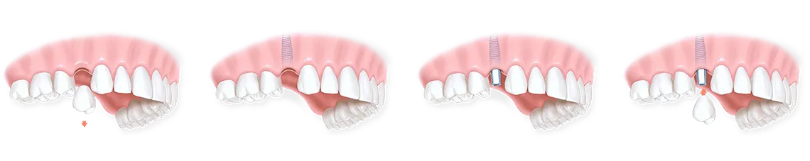 Етапи проведення одномоментної імплантації