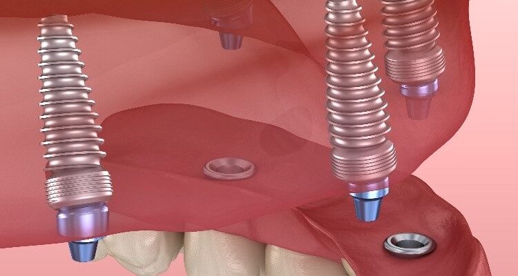 Синус-ліфтинг