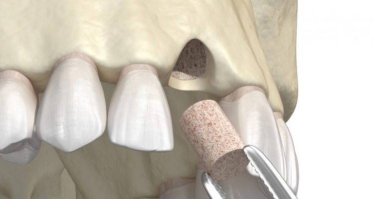 Синус-ліфтинг