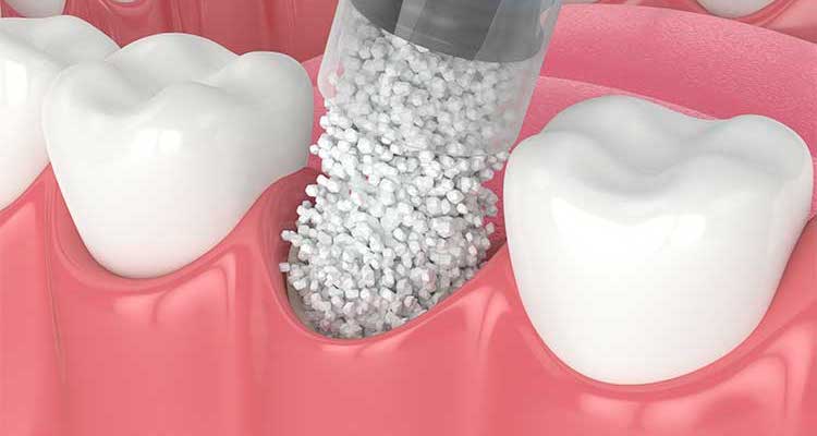 Синус-ліфтинг