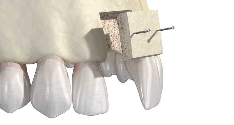 Синус-ліфтинг