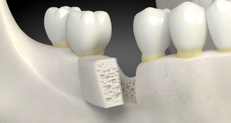 Синус-ліфтинг