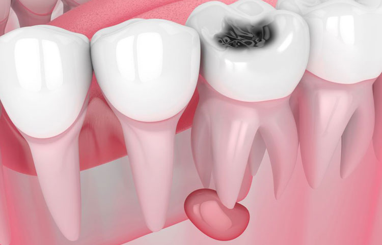 Видалення кіст