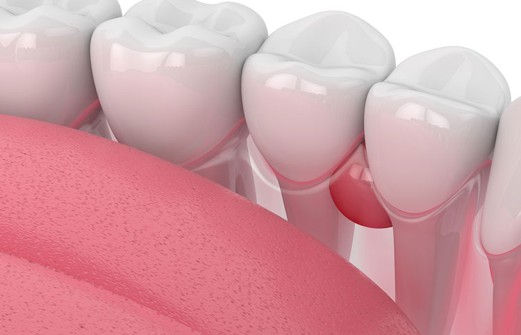 Видалення кіст