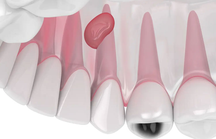 Видалення кіст