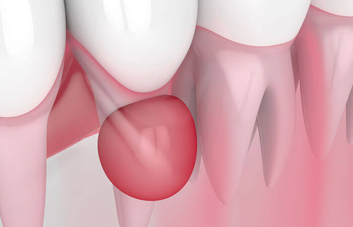 Видалення кіст