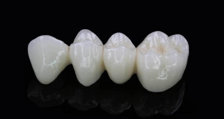 Зубні мости