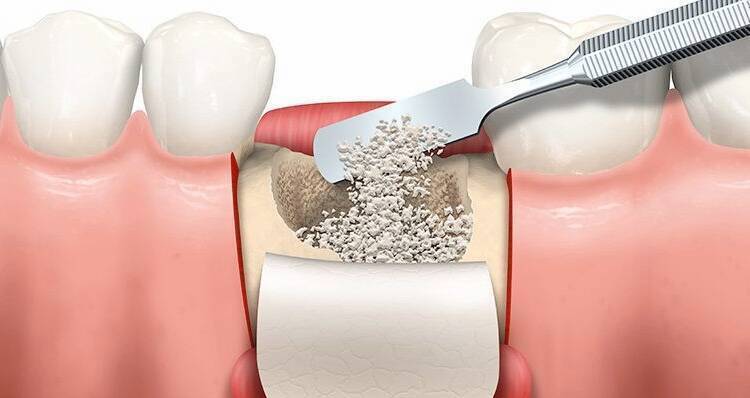 Синус-ліфтинг