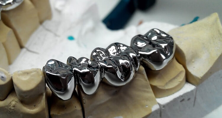 Зубні мости