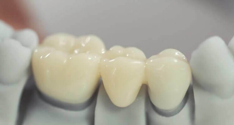 Зубні мости