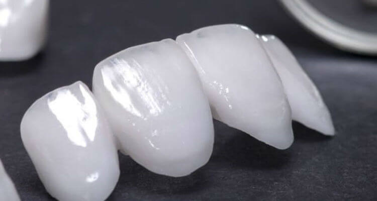 Зубні мости