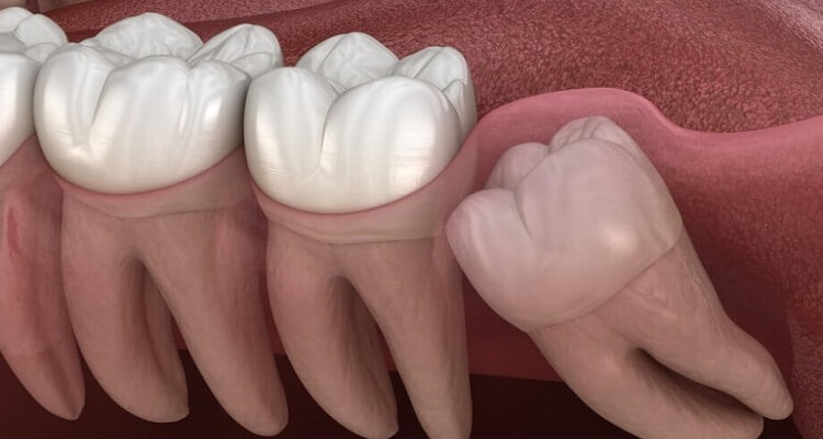 Видалення зубів